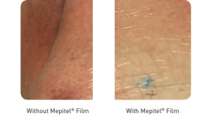 image comparing skin using mepitel film and skin without using mepitel film.